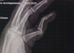 В Одессе пенсионерка напала на мужчину и сломала ему палец